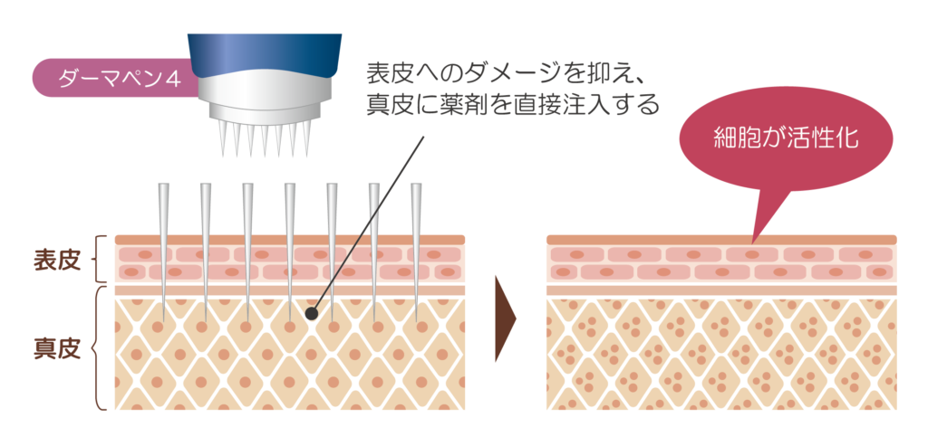 ダーマペン4