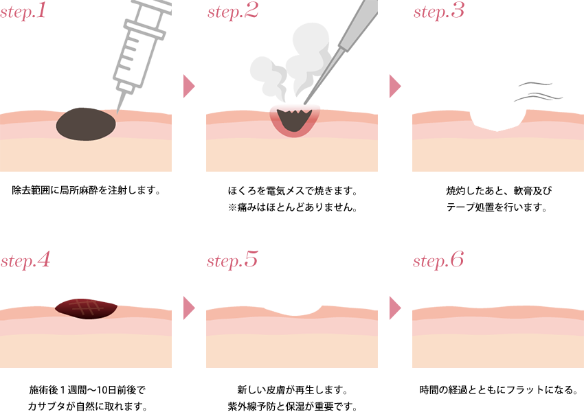 電気メスを使ったほくろ除去のメカニズム