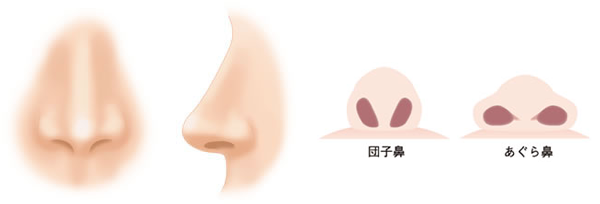 鼻の整形