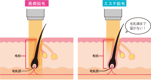 医療脱毛とエステ脱毛の違い