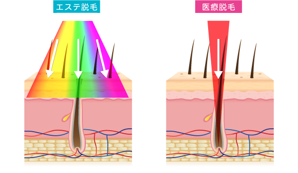 脱毛は、実は火傷のリスクが高い施術です。