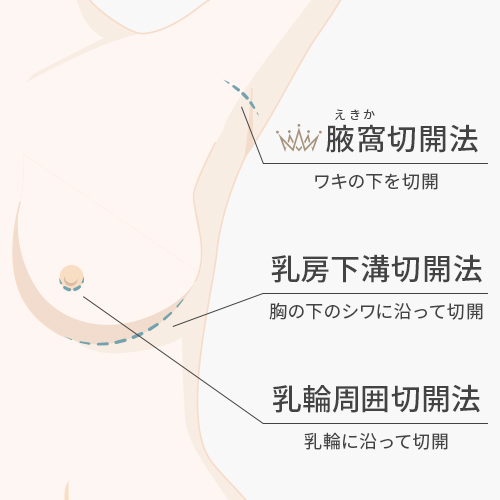 傷が目立ちにくい「腋窩切開法」