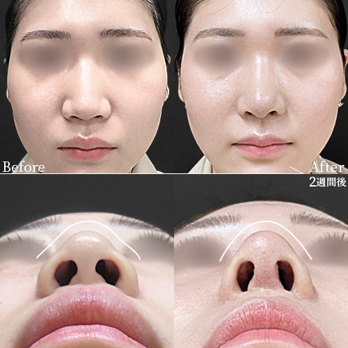 鼻フルコース（鼻複合自家組織移植術）症例