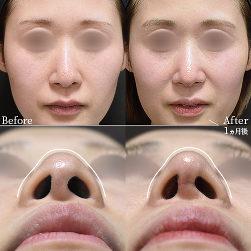 鼻尖形成術4D法症例
