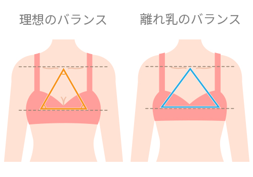 離れ乳の特徴