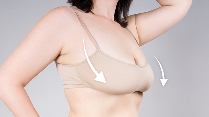 【垂れ乳の原因と改善法】自宅ケア・美容施術まで徹底ガイド