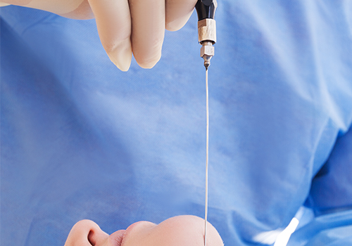 顔の脂肪吸引とは?