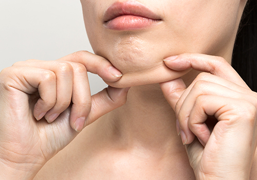 顔の脂肪吸引はこんな悩みにおすすめ