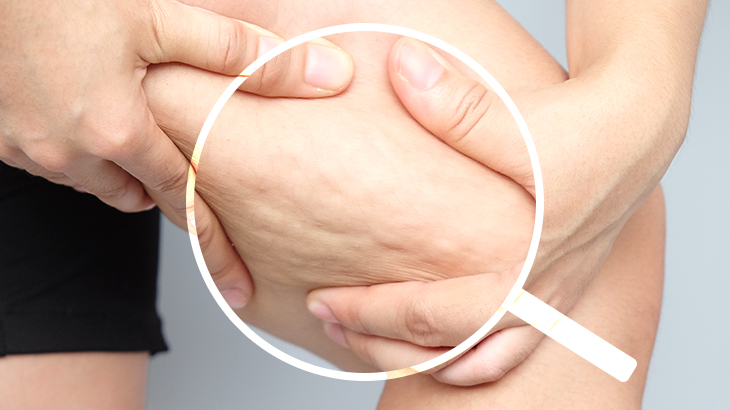 【太もものセルライトの原因と解消法】自宅ケア vs 医療施術を徹底比較