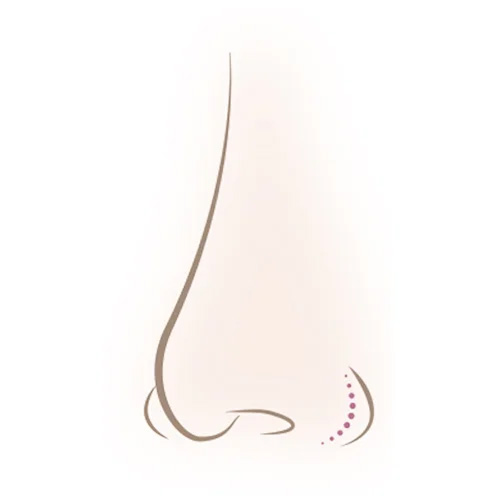 小鼻(鼻翼)が横に広がっている