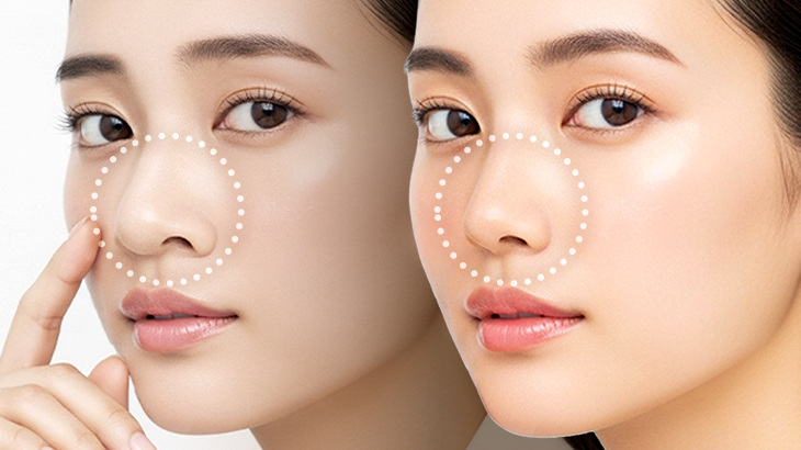 【鼻がでかい原因と整形法】“忘れ鼻”でナチュラル美鼻を実現