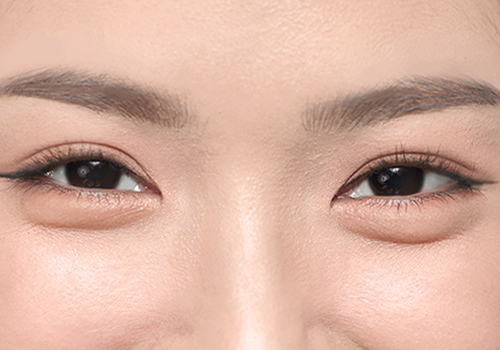 涙袋がありすぎる・目立つ原因