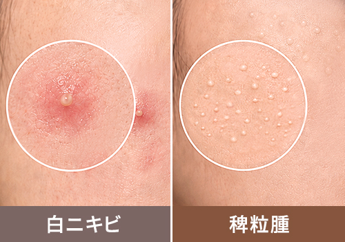 ニキビと稗粒腫の違い