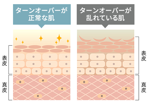 なぜできる?稗粒腫ができる主な要因