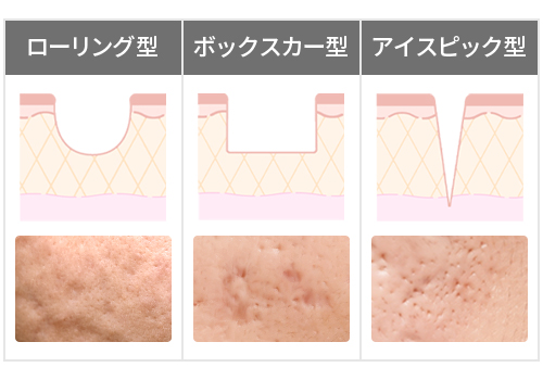 凹凸のあるニキビ跡・クレーターに対する治療