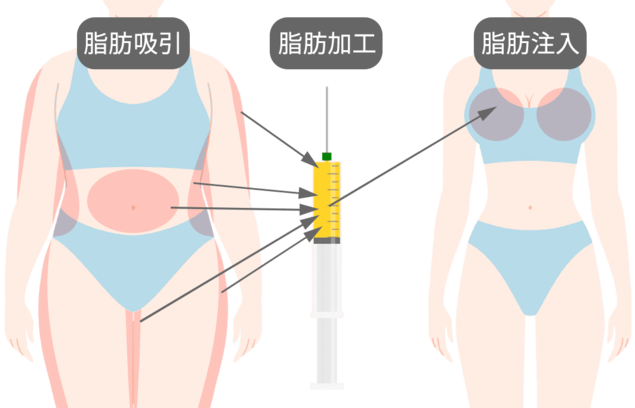 脂肪幹細胞注入豊胸