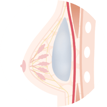 乳腺下法
