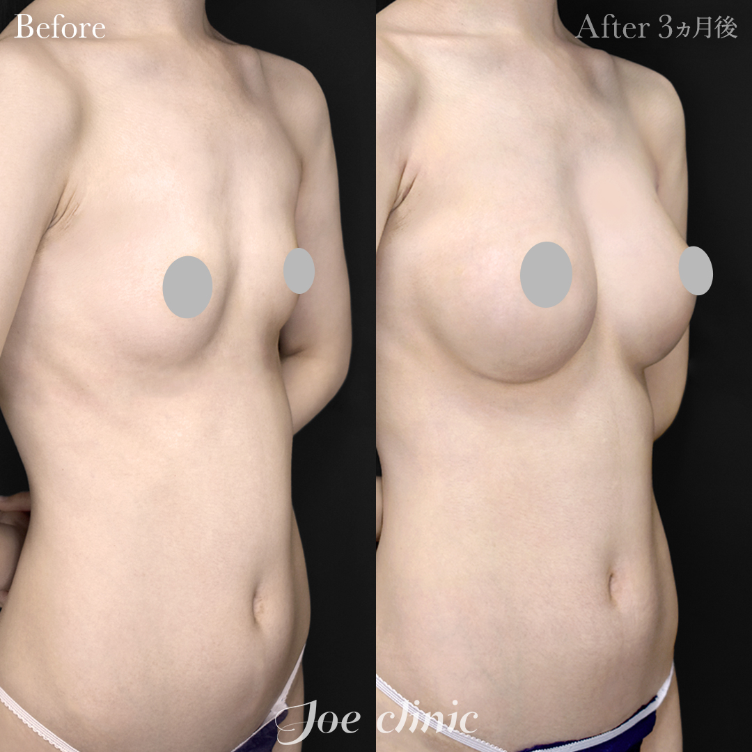 豊胸症例写真