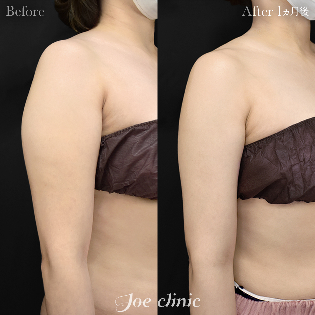 脂肪吸引症例写真