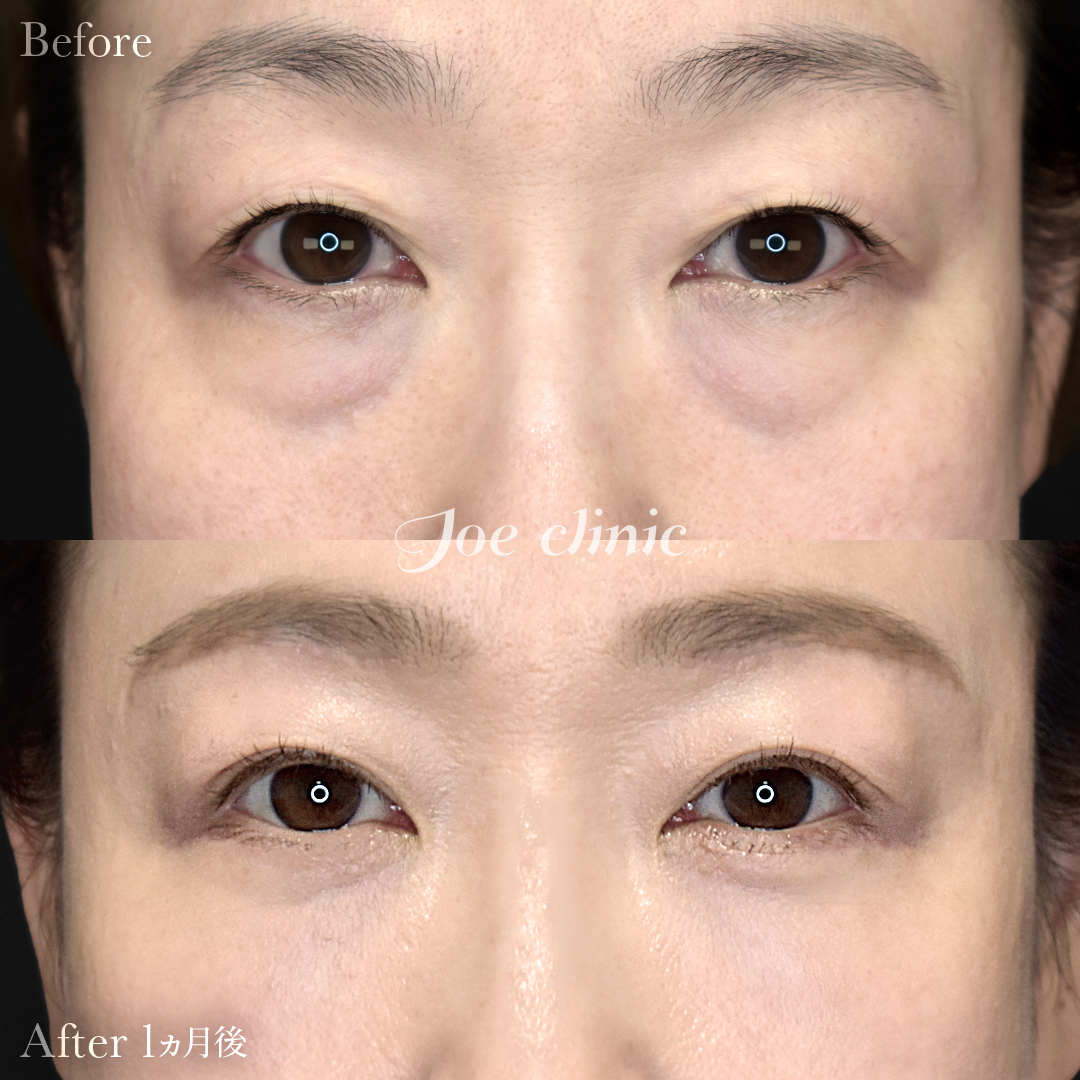 クマ取り症例写真