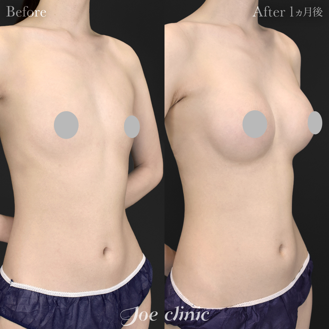 豊胸症例写真