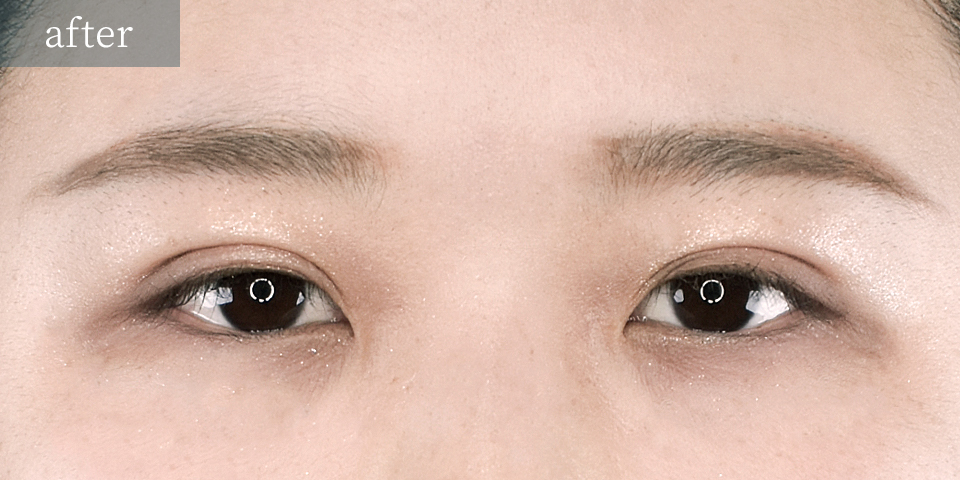 韓国式二重埋没法6点留め After