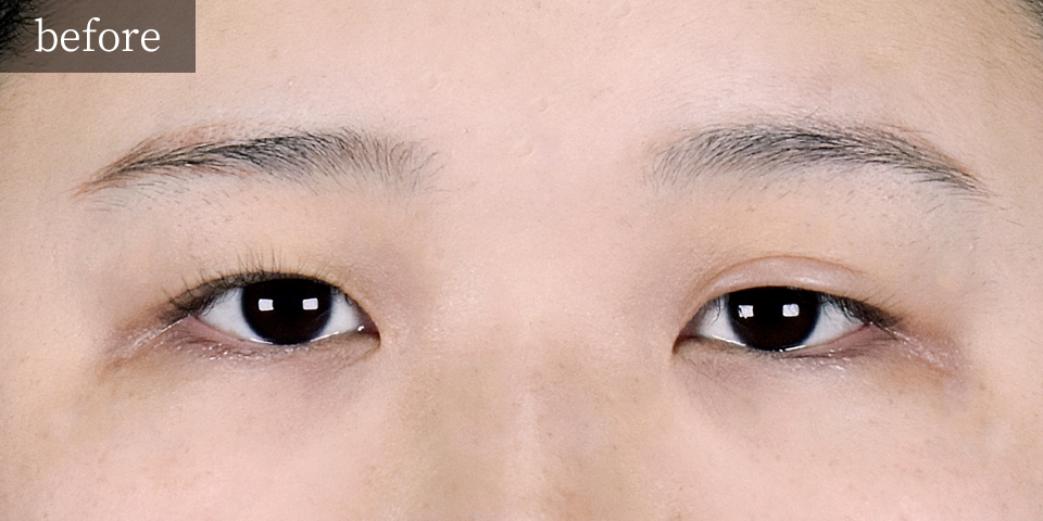 韓国式二重埋没法6点留め Before