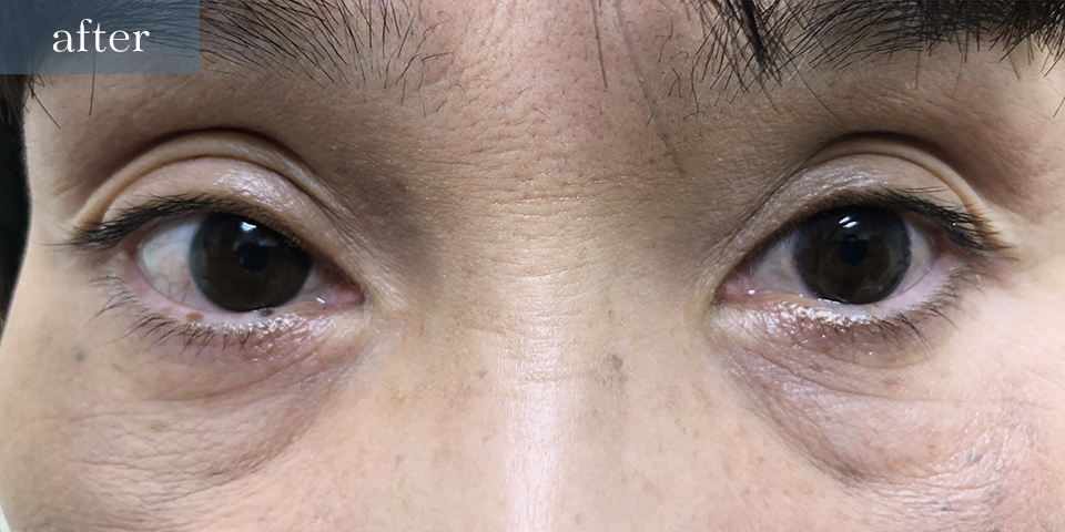 眼瞼下垂（挙筋短縮部分切開法）After