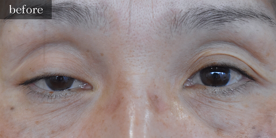 眼瞼下垂（挙筋短縮部分切開法）Before