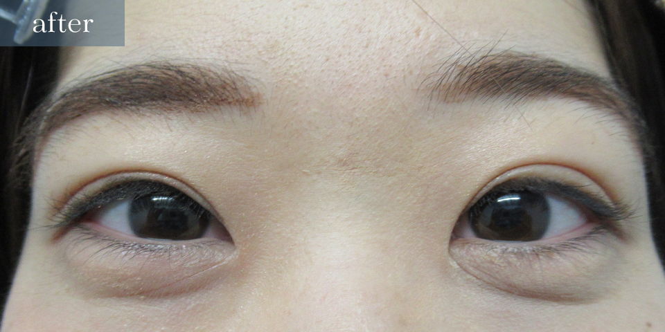 眼瞼下垂（挙筋短縮部分切開法）After