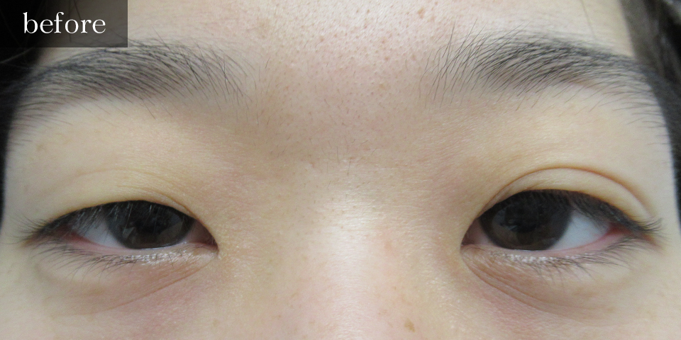 眼瞼下垂（挙筋短縮部分切開法）Before