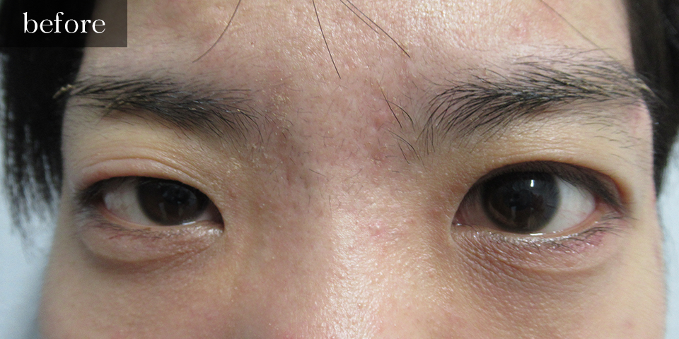 眼瞼下垂（挙筋短縮部分切開法）Before