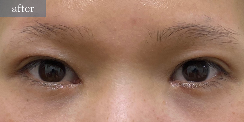 眼瞼下垂（挙筋短縮部分切開法）After