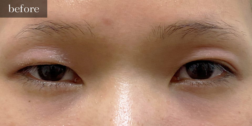眼瞼下垂（挙筋短縮部分切開法）Before