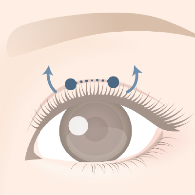 眼瞼下垂（切開法）のイメージ