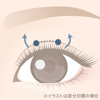 眼瞼下垂（挙筋短縮部分切開法）のイメージ