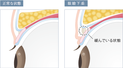 眼瞼下垂の断面図