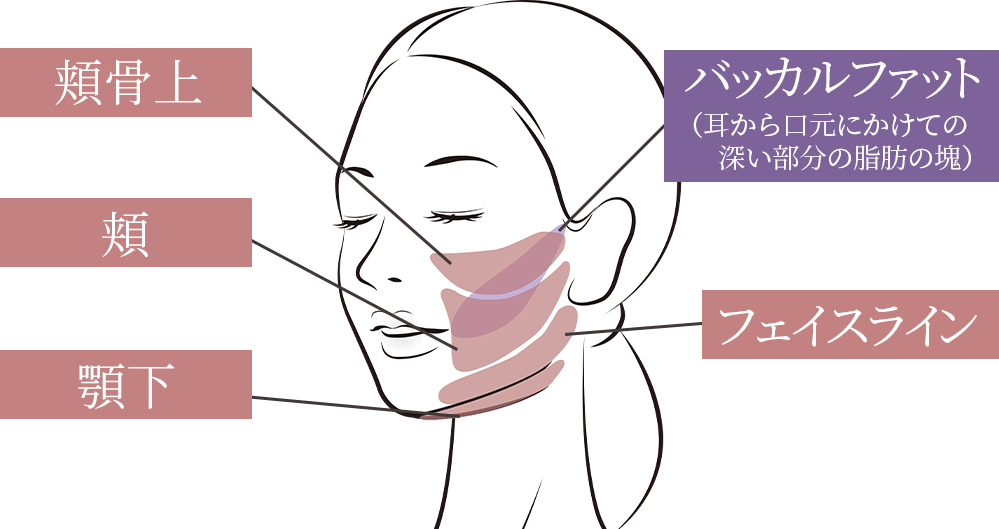 顔の脂肪吸引の部位