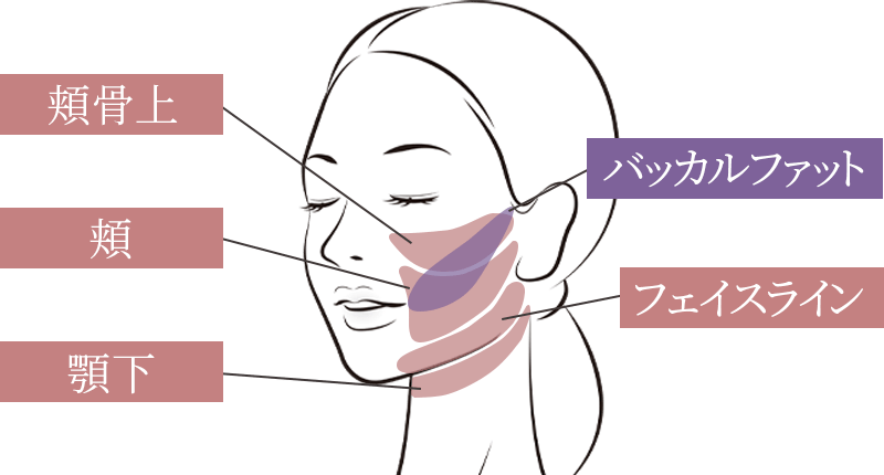 顔の脂肪吸引の部位イラスト