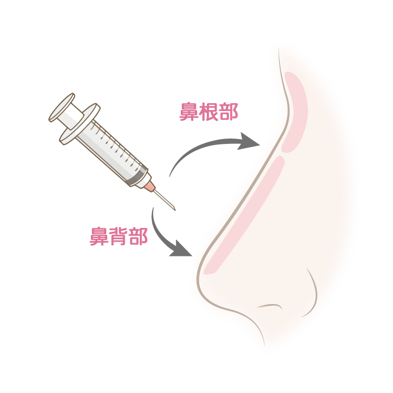 ヒアルロン酸注入イラスト