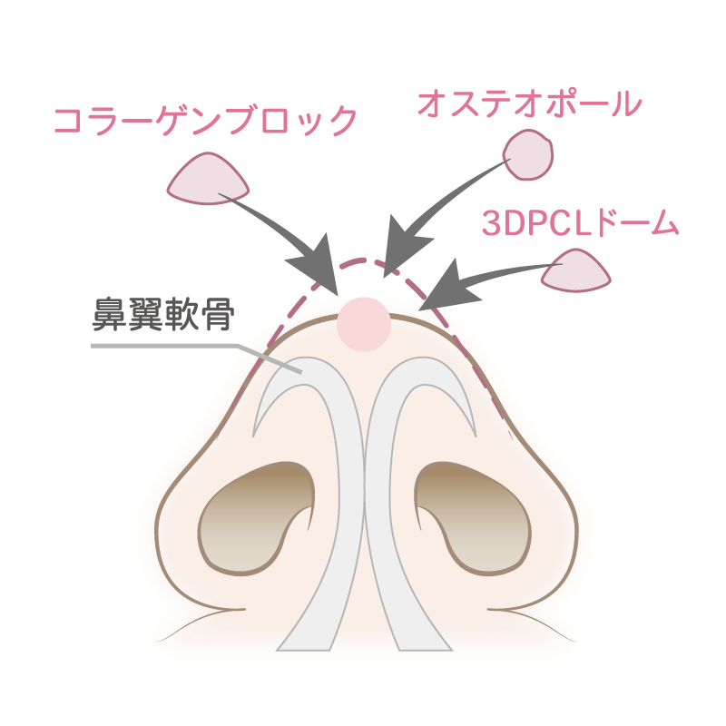 鼻尖形成術3D/4D法イラスト