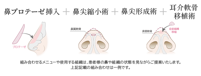 忘れ鼻セット