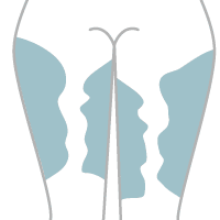 広範囲の色素沈着