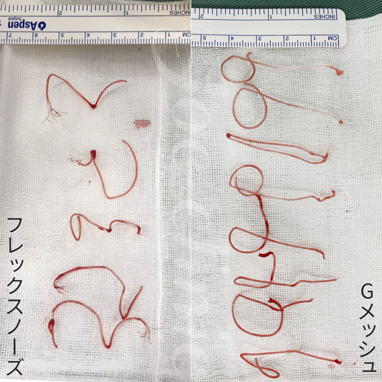 溶ける糸除去の実例