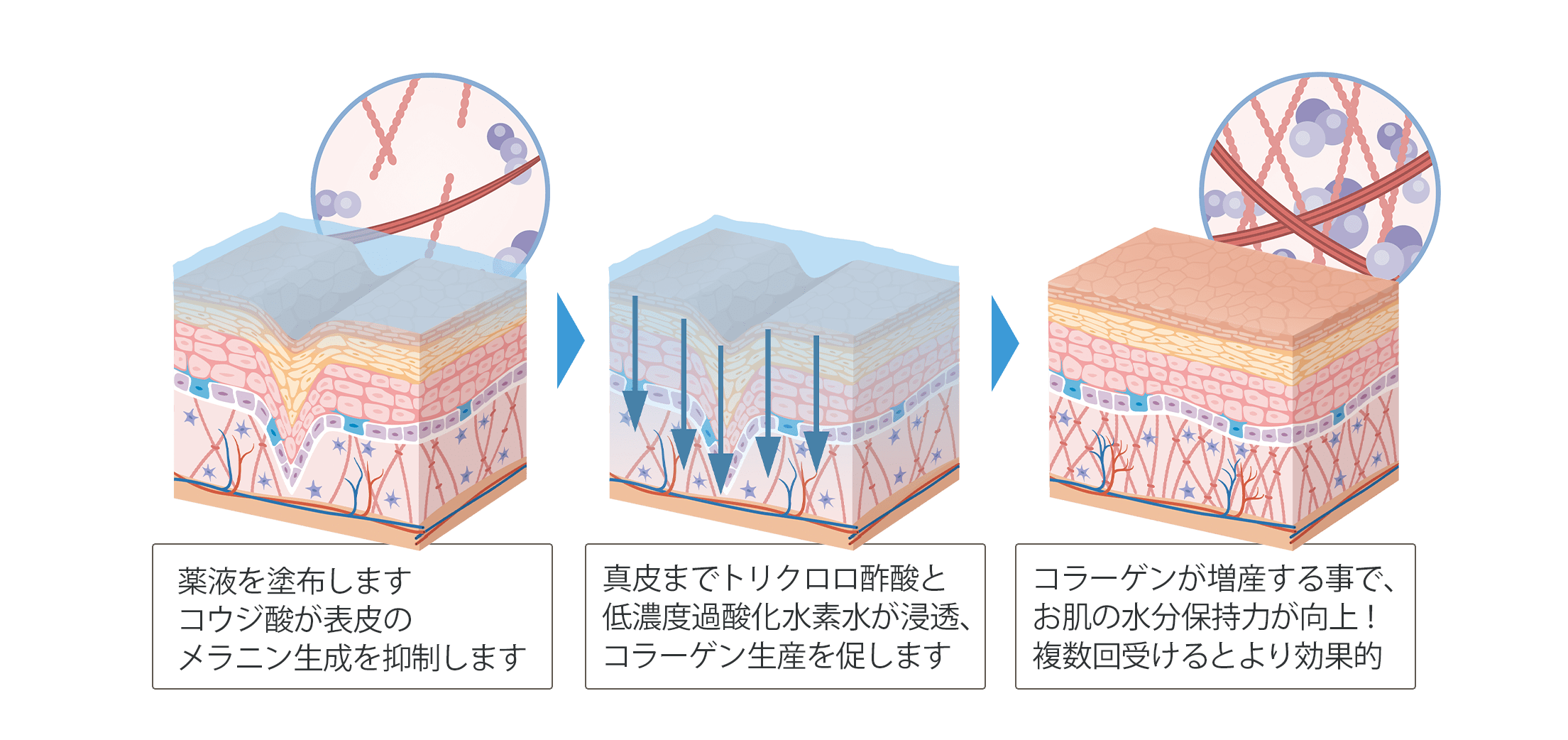 マッサージピール施術イラスト