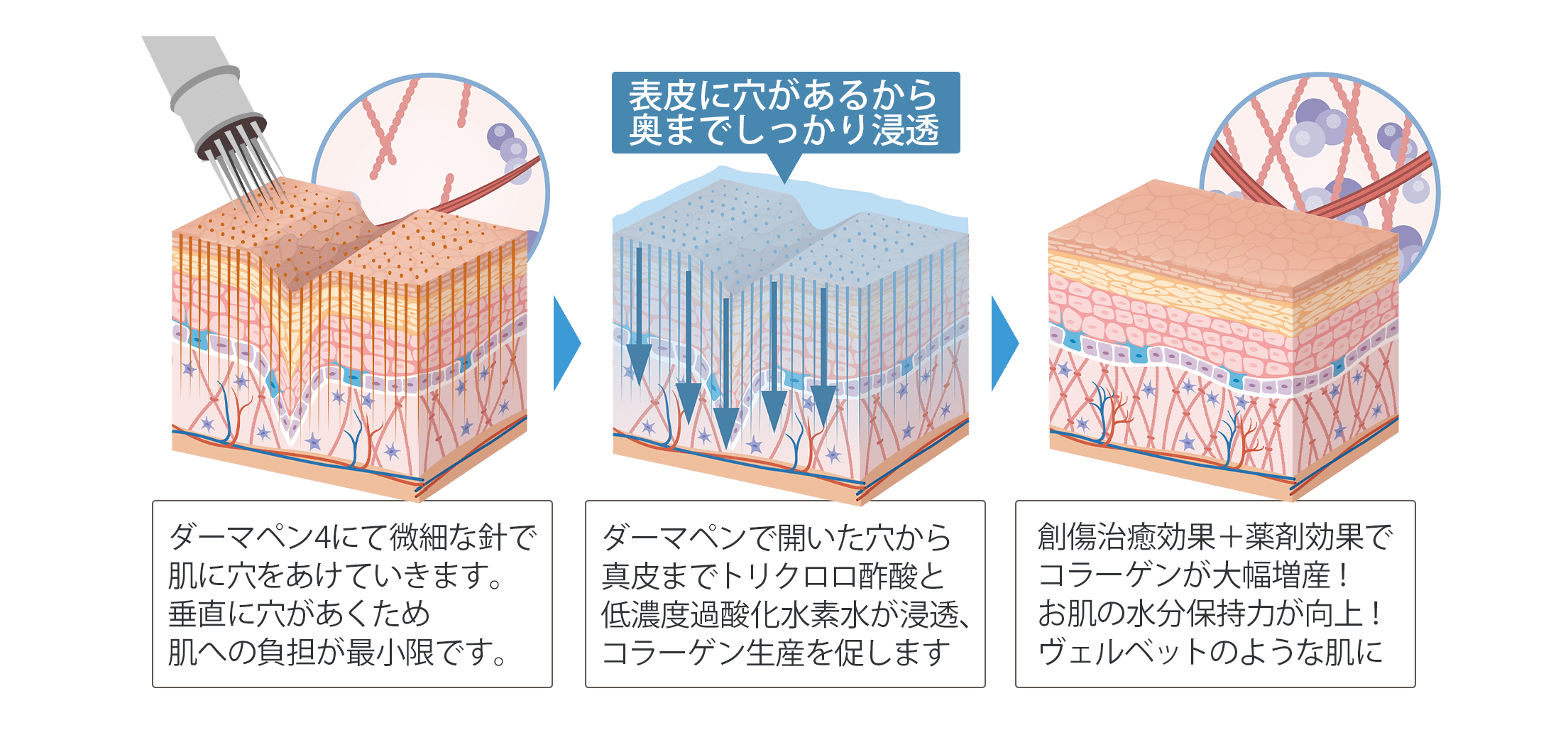 ヴェルベットスキン施術イラスト