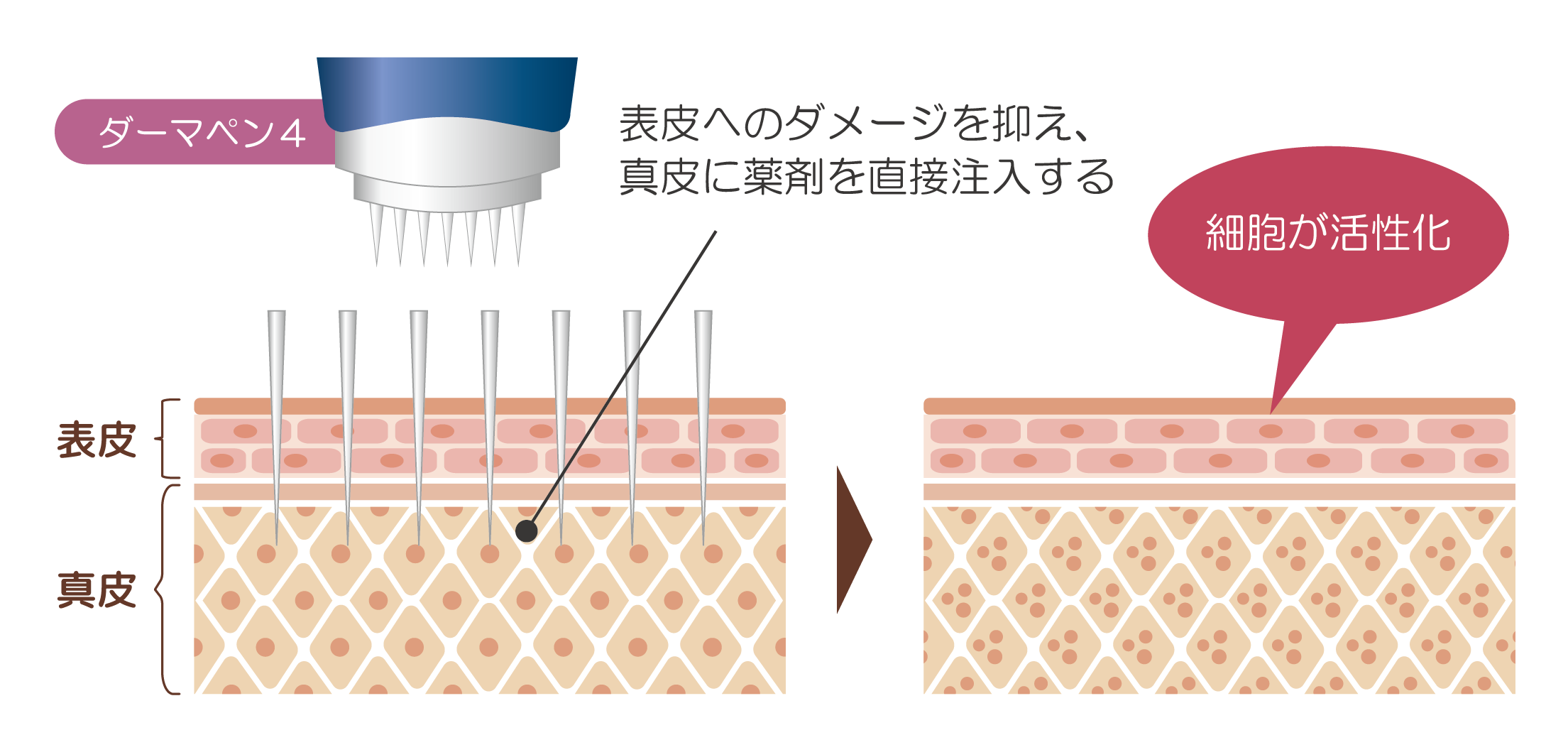 ダーマペン4施術イラスト