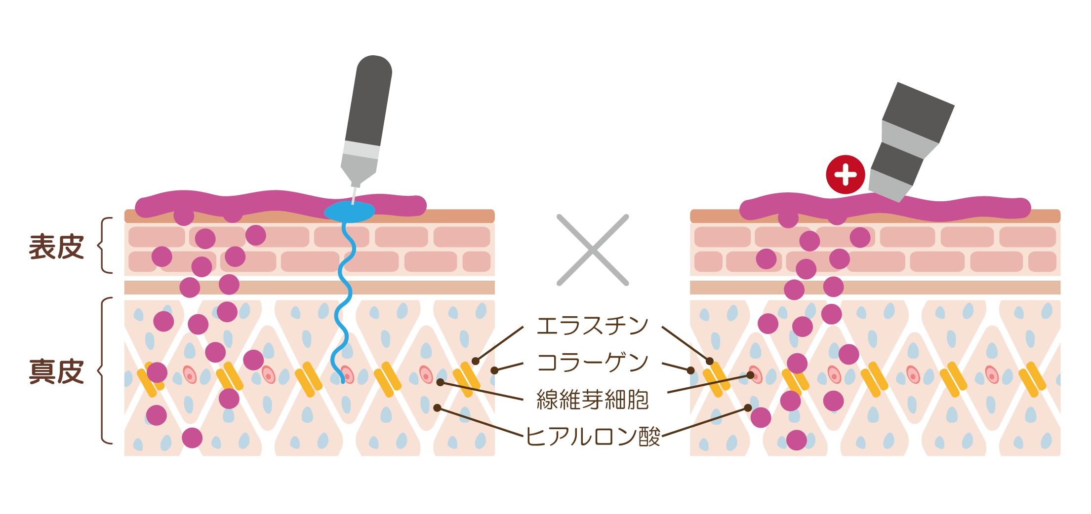 メソナJ施術イラスト