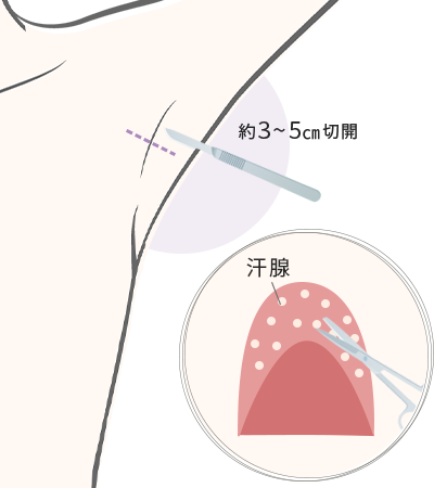 ワキガ手術（皮弁法）
