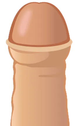 仮性包茎の状態を示すイラスト